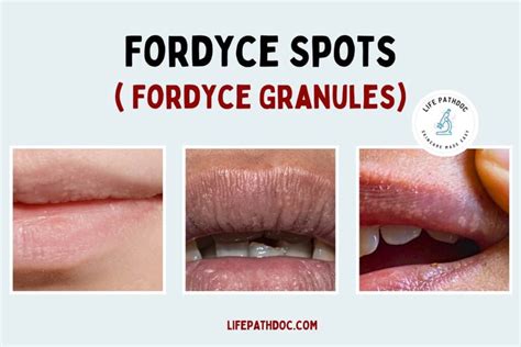 grain de fordyxe|Fordyce spots: Quick and Informative guidance